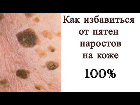 Видео: 🟡🔵 Пятна и наросты на лице , шее , кожи тела … как избавиться ( дополнение) ЧАСТЬ - 2