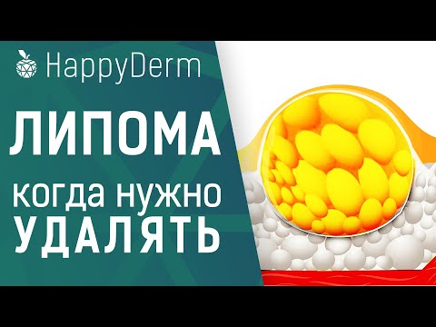 Видео: ЛИПОМА — ЧТО ЭТО ТАКОЕ, ОПАСЕН ЛИ ЖИРОВИК НА ТЕЛЕ И КАК УДАЛИТЬ ЛИПОМУ