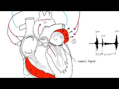 Видео: Митральный стеноз.