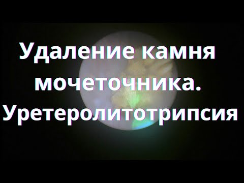 Видео: Удаление камня верхней трети мочеточника. Контактная уретеролитотрипсия. Случай #7