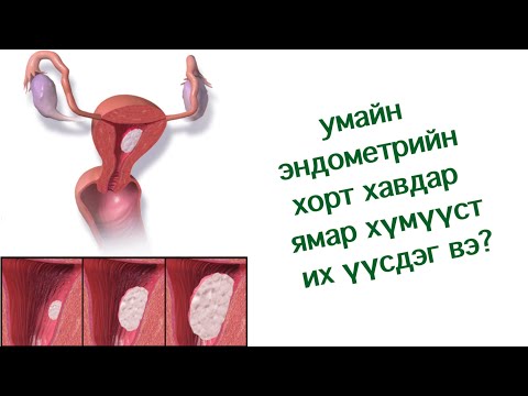 Видео: умайн эндометрийн хорт хавдар залуужиж байгаа шалтгаан