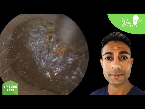 Видео: 1353 — Пациент с заложенностью левого уха после простуды, перелета и плавания во время отпуска