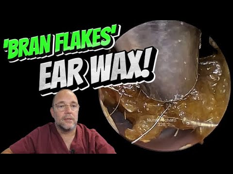 Видео: Отруби от ушной серы! 328 #ухо #ушнаясера #удалениеушнойсеры #asmr #удовлетворение #длявас #fyp #...