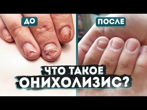 Видео: ОНИХОЛИЗИС. ЧТО ЭТО ТАКОЕ И КАК ЕГО ЛЕЧИТЬ? | Мнение подолога | Лечение | Диагностика | Профилактика