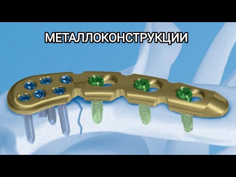Видео: Металлоконструкции в травматологии и ортопедии