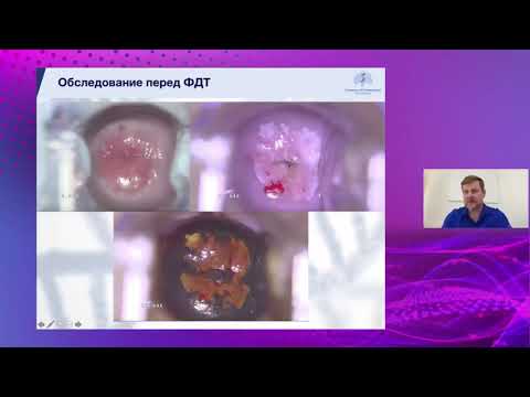 Видео: Исследование противоопухолевой и противовирусной эффект. ФДТ с лёгкой/тяжелой дисплазией шейки матки