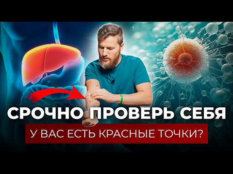 Видео: О чем говорят КРАСНЫЕ ТОЧКИ на теле. Гемангиома - опухоль или слезы печени?