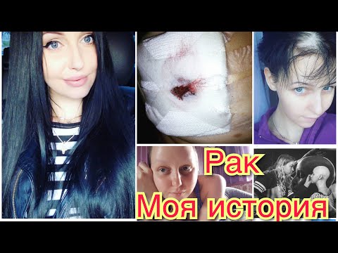 Видео: Рак Молочной железы|Мой Ад|Как я выжила|Моя история(Часть 1)