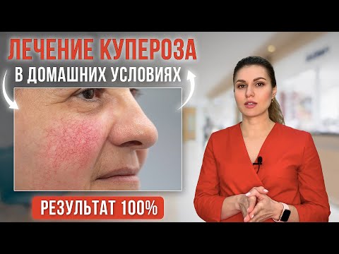 Видео: Купероз на лице как избавиться, почему появляется. Лечение купероза в домашних условиях.