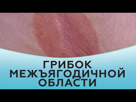 Видео: Грибок межъягодичной области