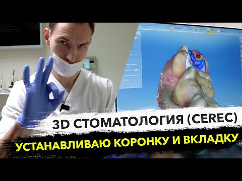 Видео: Кариес зубов лечение вкладками CEREC Церек Vita Suprinity #vitazahnfabrik