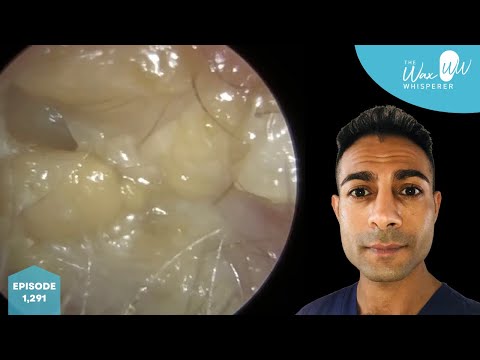 Видео: 1291 - Грибковая инфекция уха (отомикоз)