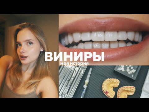 Видео: Поставила керамические виниры 🦷| моя история зубов
