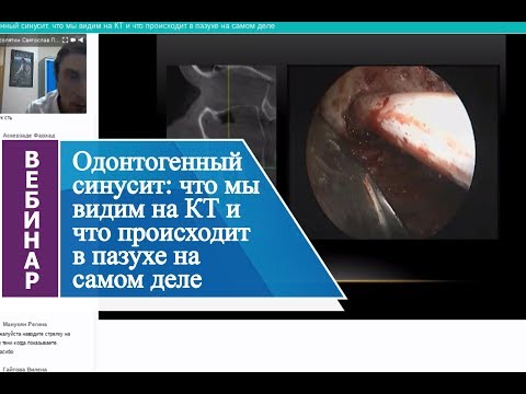 Видео: Вебинар "Одонтогенный синусит: что мы видим на КТ и что происходит в пазухе на самом деле"