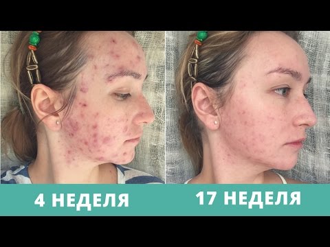 Видео: Дневник АКНЕкутана 14. Два прыща и депрессия