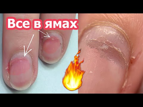 Видео: Пропилы на ногтях - Что Делать!? Безопасный Комби маникюр и Наращивание