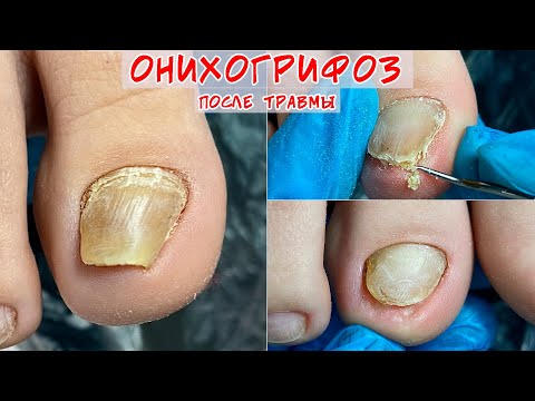 Видео: Онихогрифоз / Толстый ноготь на ноге