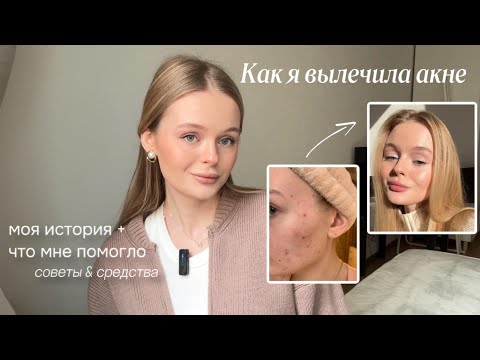 Видео: КАК Я ВЫЛЕЧИЛА АКНЕ: моя история лечения проблем с кожей 🙌🏻🫧🪷