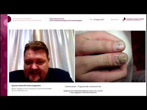 Видео: Алексей Цыкин "Профилактика грибковой инфекции кожи стоп и ногтей"
