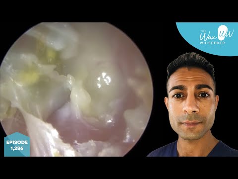 Видео: 1286 - Зудящая отмершая кожа, скрывающая патологию ушного канала