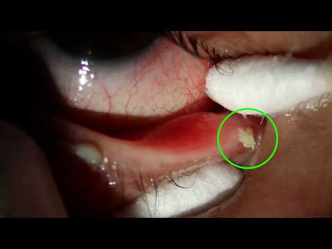 Видео: Удаление камня слёзного канала