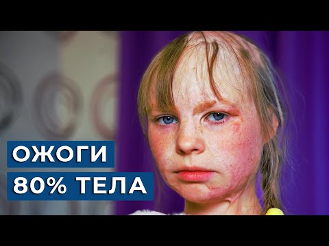 Видео: 🔥 Моя дочь ЧУТЬ НЕ СГОРЕЛА заживо / Ожог 80% тела, Алеся 9 лет