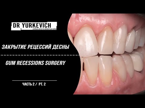 Видео: Закрытие рецессий десны на нижней челюсти ч. 2 / Lower jaw gum recessions coverage surgery pt.2