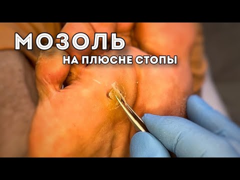 Видео: Плотное, жесткое, округлой формы на стопе
