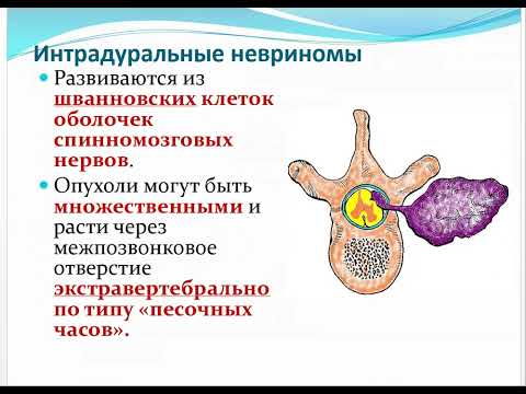 Видео: Опухоли спинного мозга