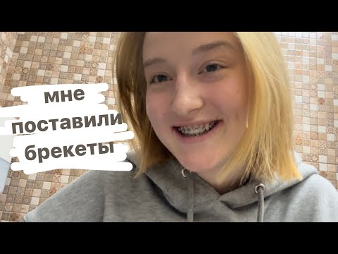 Видео: как мне поставили брекеты//как это было? уход, переживания и тд