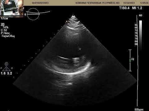 Видео: УЗИ сердца через 3  месяца после обширного инфаркта. ФВ 25%