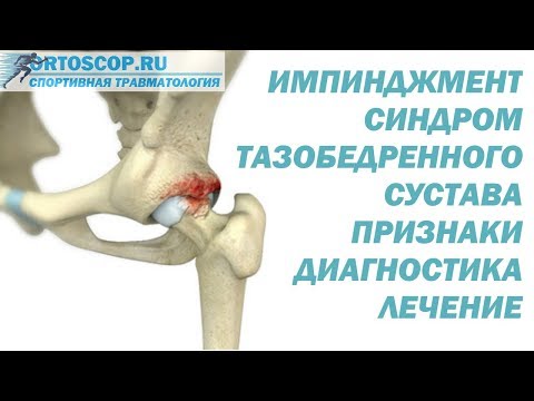 Видео: ИМПИНДЖМЕНТ СИНДРОМ ТАЗОБЕДРЕННОГО СУСТАВА