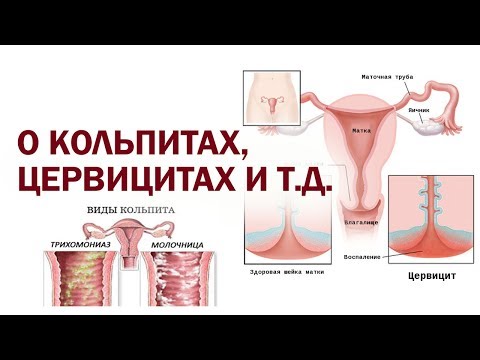 Видео: Кольпит, цервицит, молочница и многое другое @DrOlenaB