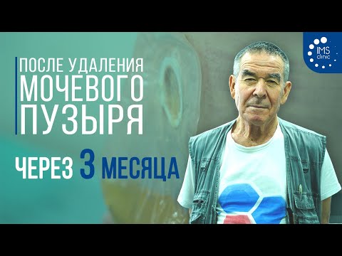 Видео: Рак мочевого пузыря  Через 3 месяца после удаления мочевого пузыря