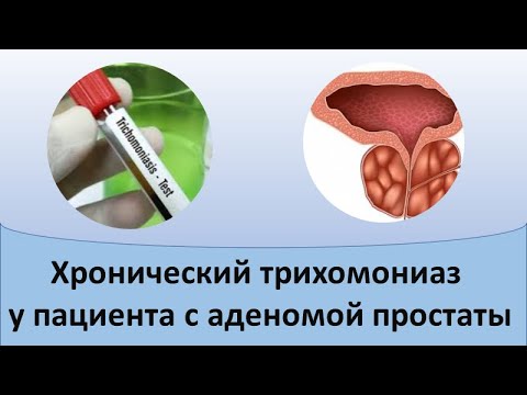 Видео: Хронический трихомониаз у пациента с аденомой простаты