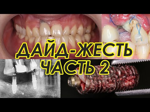 Видео: Дайд-жесть? Часть 2: успехи, осложнения, рассуждения про биологическую ширину в области имплантатов