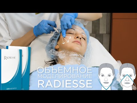 Видео: Векторный лифтинг лица | Используем Radiesse как волюмайзер и армирант