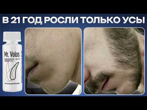 Видео: ПРОБИЛ РОСТ БОРОДЫ ЗА 3 МЕС / Результаты лосьона для бороды mr.Volos