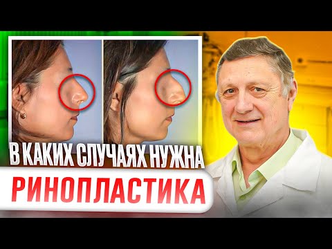 Видео: Признаки того, что вам действительно нужна пластика носа