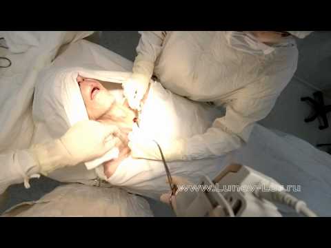 Видео: Трахеостомия