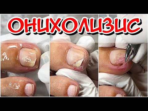 Видео: ОНихолизис / Зачистка / Зачистка Онихолизиса / Скрученный ноготь / Болит ноготь что делать?