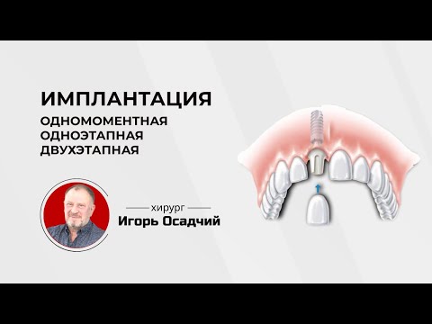 Видео: Что такое одномоментная, одноэтапная, двухэтапная имплантация