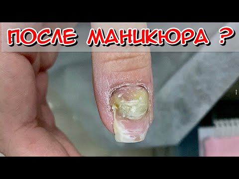 Видео: После маникюра? / Травма ногтя / Гной под ногтем что делать? / Онихолизис / Зачистка ногтя