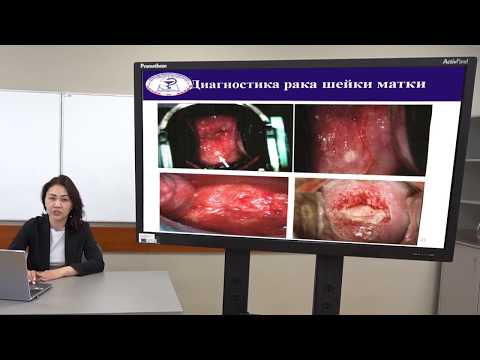 Видео: Лекция "Рак шейки матки"