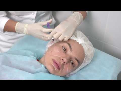 Видео: Контурная пластика для средней и нижней трети лица . Филлер Миралайн