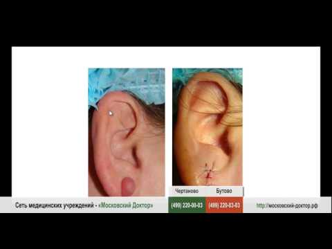 Видео: Атерома мочки уха