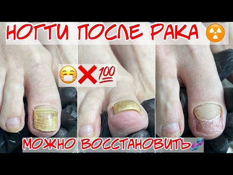 Видео: Восстановление ногтей после химиотерапии