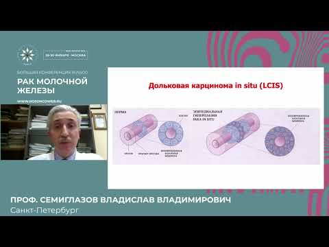Видео: Дольковая карцинома in situ, современный взгляд на проблему