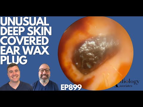 Видео: Необычная ушная серная пробка, глубоко покрытая кожей - EP899