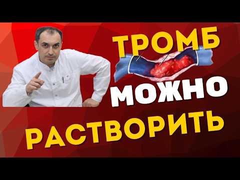 Видео: Как женщина избавилась от тромбоза. Флеболог Москва.